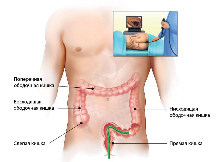 Что такое колоноскопия и для чего она нужна?